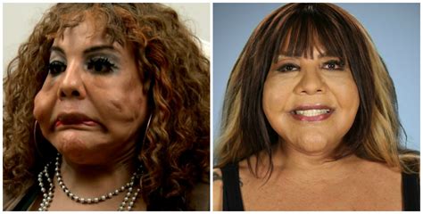 Controversial Plastic Surgeries and Transformations